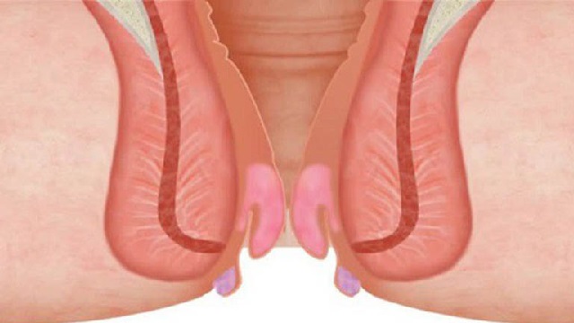 7 Món ngon bổ cho người bệnh trĩ nên ăn mỗi ngày