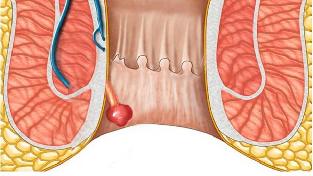 Bị polyp hậu môn nên ăn gì ?