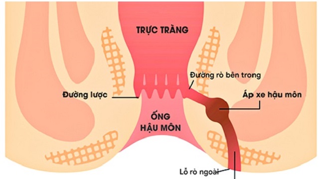 Bị rò hậu môn nên ăn gì và kiêng gì giúp bệnh mau khỏi?