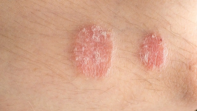 Biểu hiện ngoài da cảnh báo dấu hiệu vấn đề đường tiêu hoá