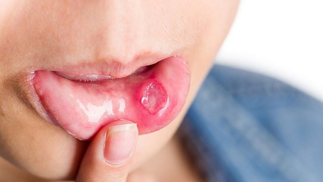 Biểu hiện ngoài da cảnh báo dấu hiệu vấn đề đường tiêu hoá