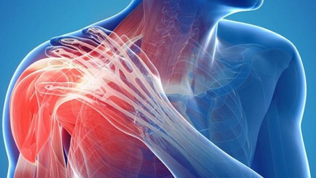 Các thể viêm quanh khớp vai và triệu chứng đi kèm