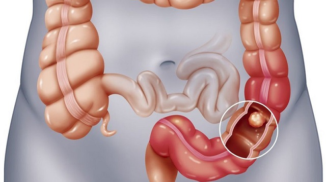 Cảnh giác với tình trạng đau bụng, đi ngoài kèm sốt sau khi ăn