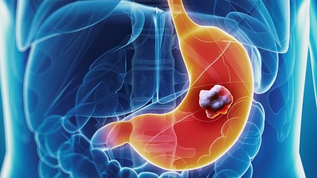 Chẩn đoán triệu chứng đau vùng thượng vị vào ban đêm