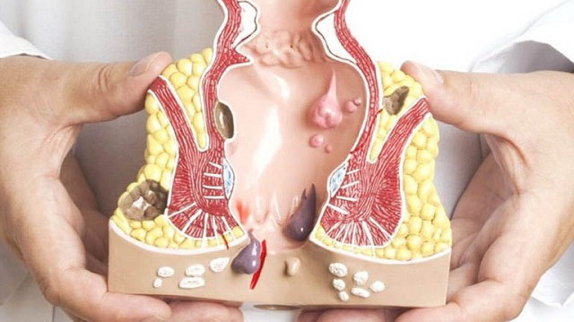 Chế độ ăn uống hợp lý cho người mắc bệnh trĩ