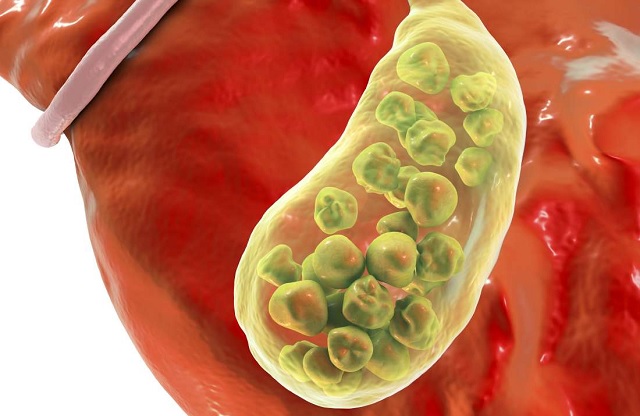 Đau hạ sườn phải là dấu hiệu bệnh gì?