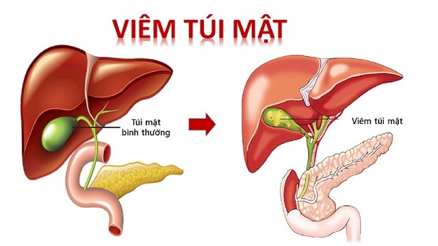 Đau hạ sườn phải là dấu hiệu bệnh gì?