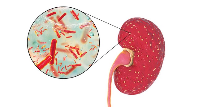 Đau hạ sườn phải là dấu hiệu bệnh gì?