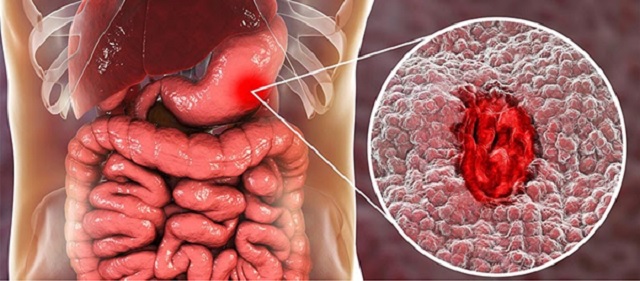 Dấu hiệu nhận biết loét dạ dày tá tràng do stress gây ra