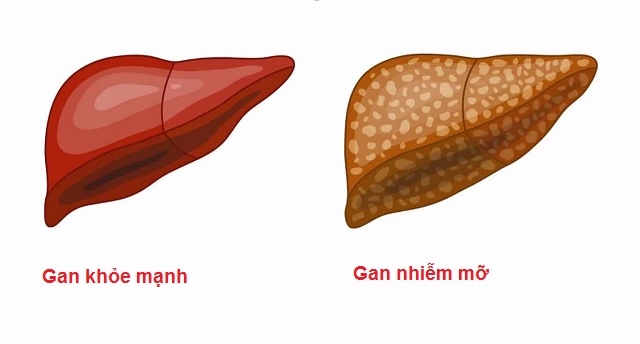 Những người có nguy cơ cao bị bệnh gan nhiễm mỡ