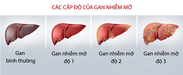 Những người có nguy cơ cao bị bệnh gan nhiễm mỡ