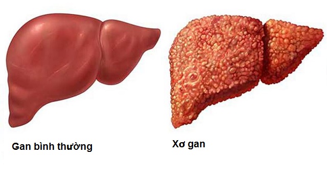 Những người có nguy cơ cao bị bệnh gan nhiễm mỡ
