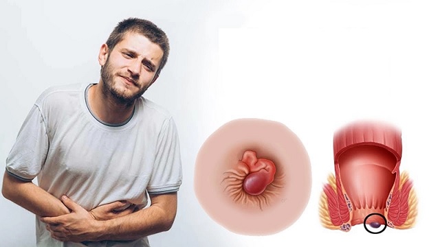 Người bệnh trĩ nên ăn uống như thế nào trong dịp Tết?