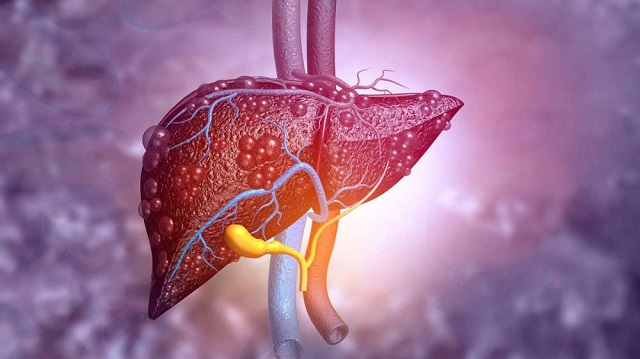Những cách hiểu sai lầm về bệnh gan nhiễm mỡ