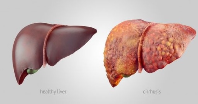 Những cách hiểu sai lầm về bệnh gan nhiễm mỡ