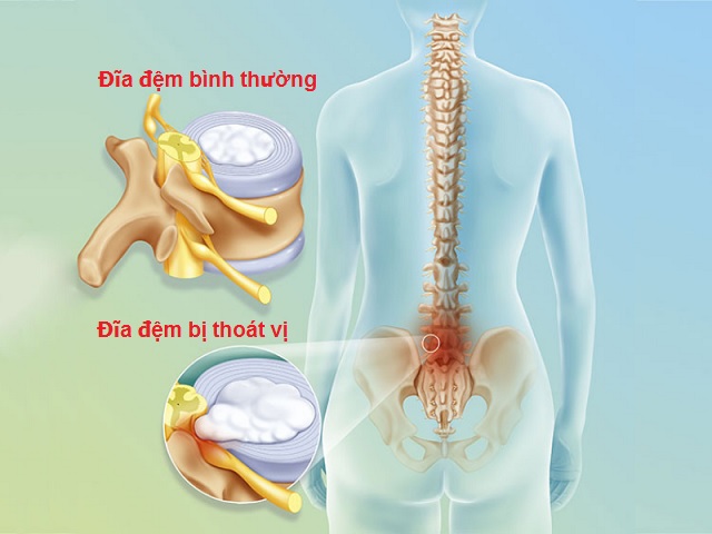 Những điều phải cân nhắc trước khi quyết định mổ thoát vị đĩa đệm