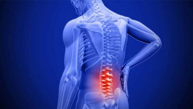 Những điều phải cân nhắc trước khi quyết định mổ thoát vị đĩa đệm