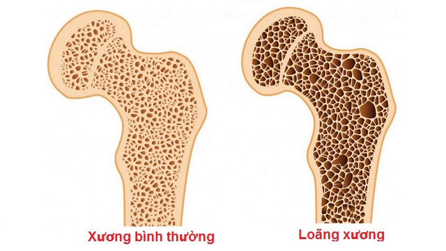 Những thói quen vàng giúp phòng ngừa loãng xương hiệu quả