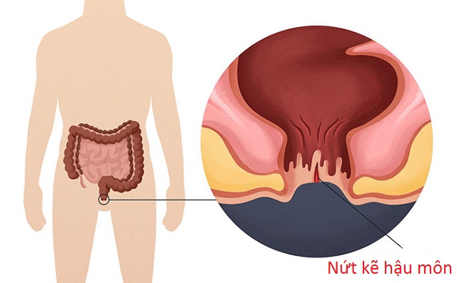 Nứt kẽ hậu môn nên ăn gì ?