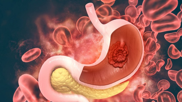Stress có mối liên hệ mật thết với bệnh dạ dày