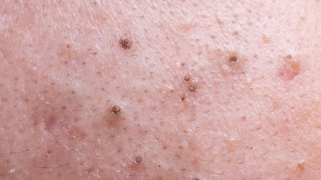 Thực phẩm giúp giảm mụn đầu đen hiệu quả từ bên trong