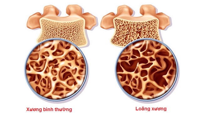 Thực phẩm ngừa loãng xương cho phụ nữ mãn kinh