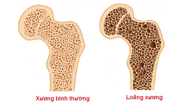 Thực phẩm dùng trong bữa ăn hàng ngày có thể phòng ngừa loãng xương